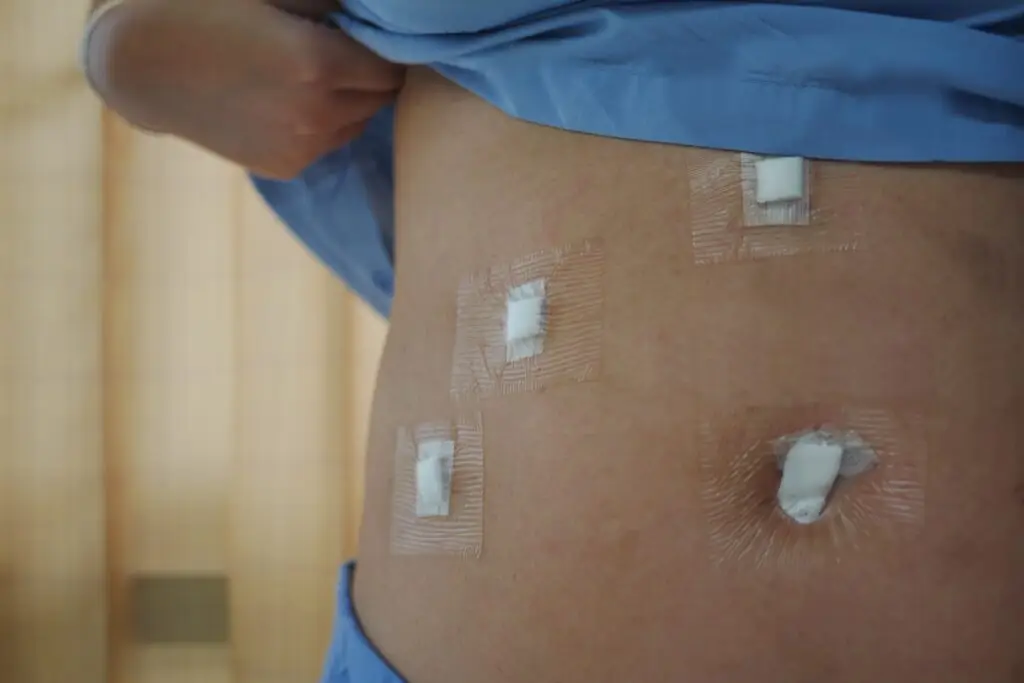 Keyhole surgery to remove the gallbladder - port sites