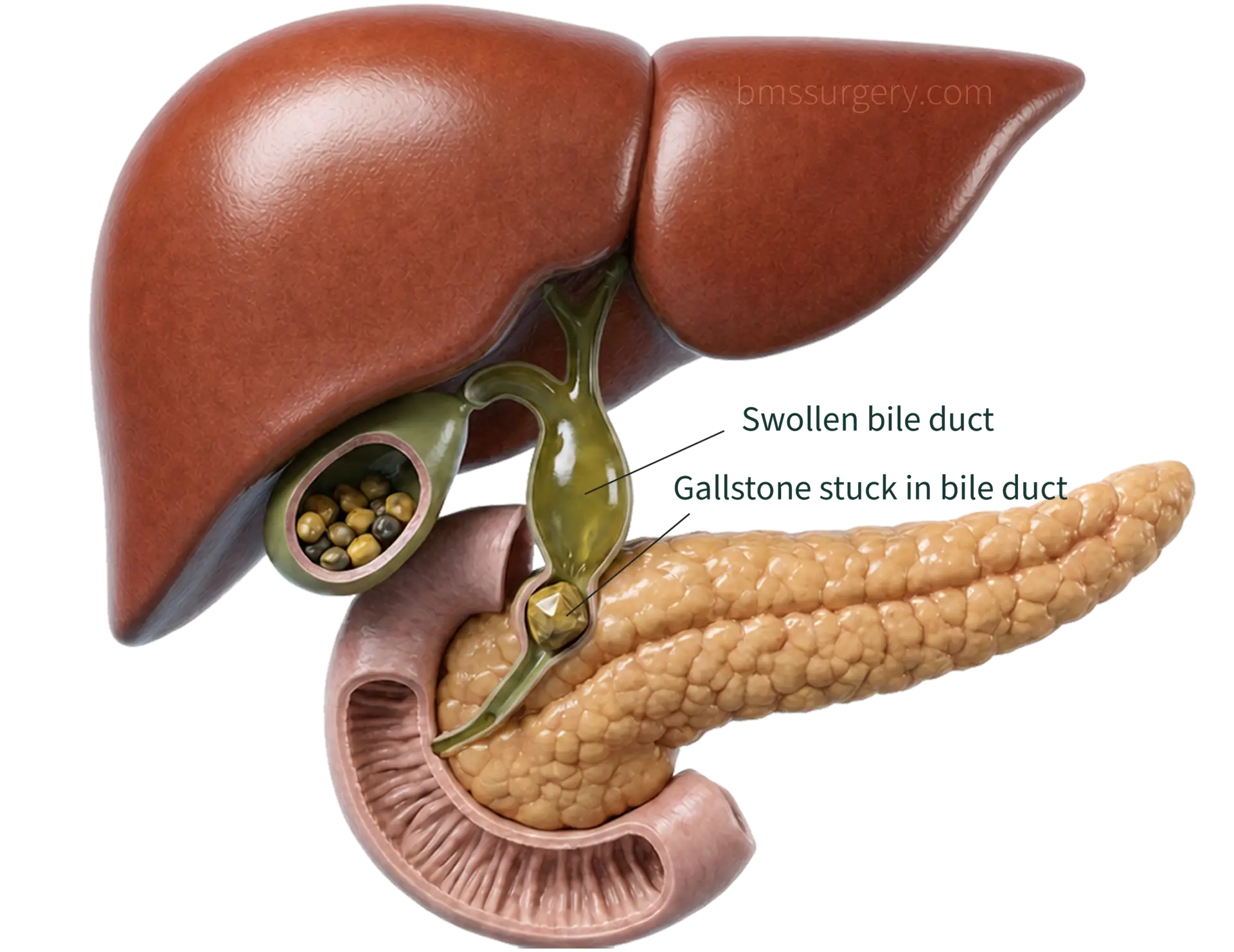 gallstone in bile duct