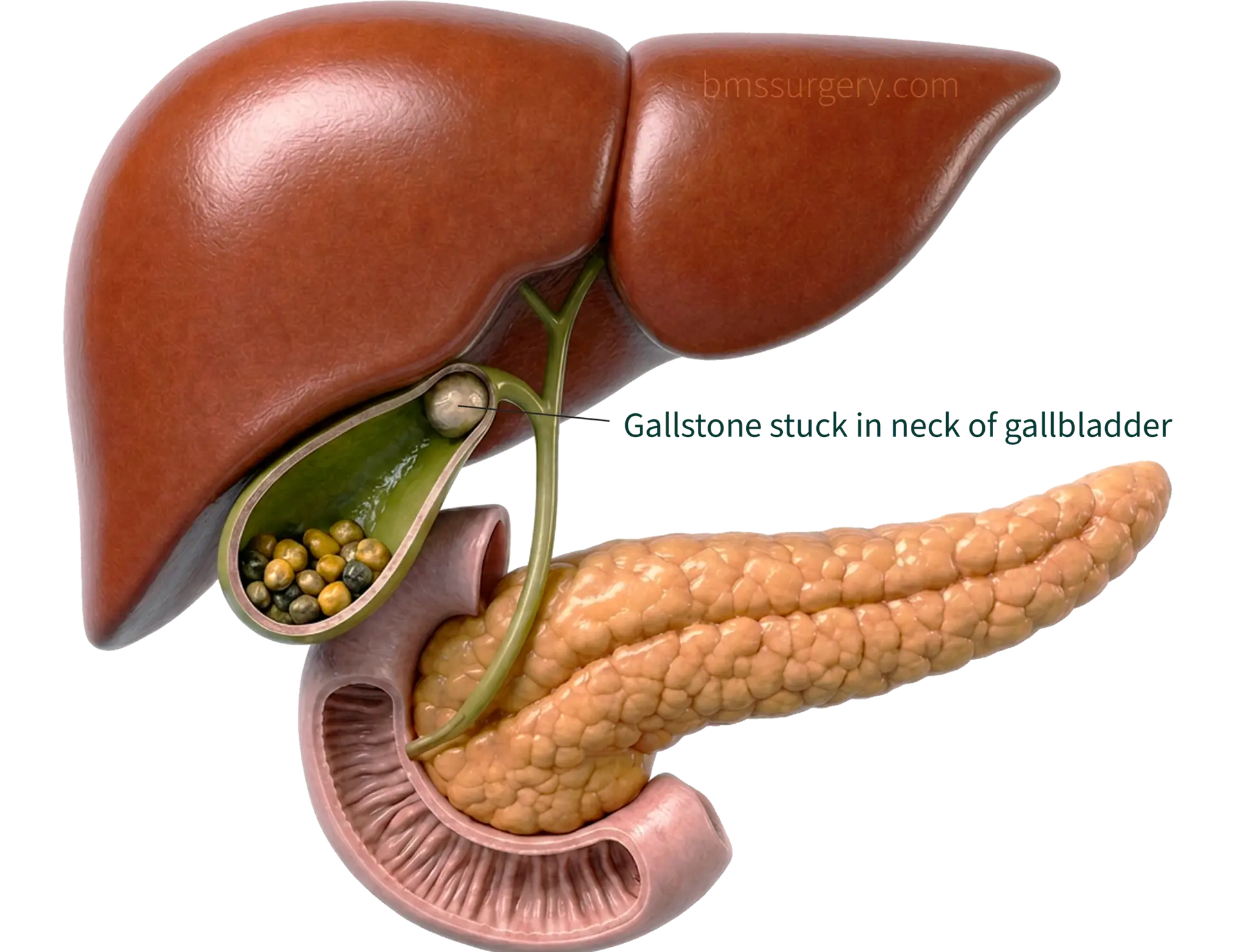gallstone in neck of gallbladder