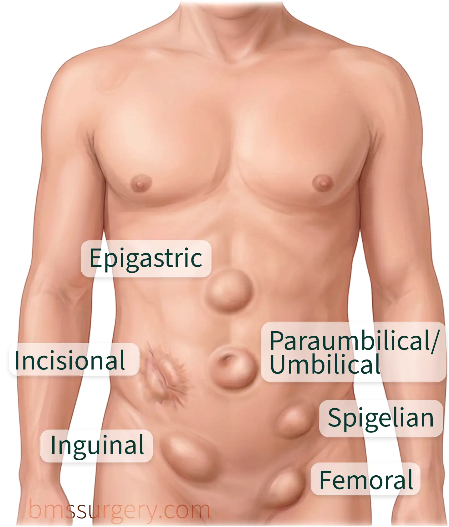 Diagram of a torso showing where epigastric, umbilical, incisional, Spigelian, inguinal and femoral hernias occur